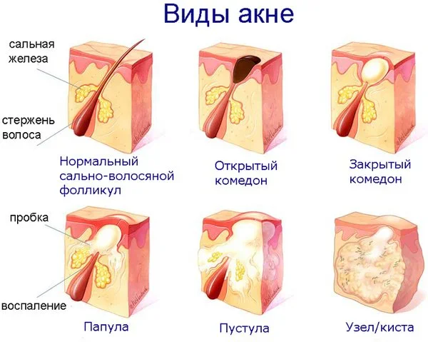 Акне: что такое акне на лице, причины, симптомы. Лечение акне на лице в клинике ROSH